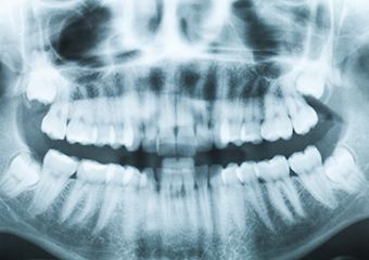 顎関節症の治療方法 イメージ画像