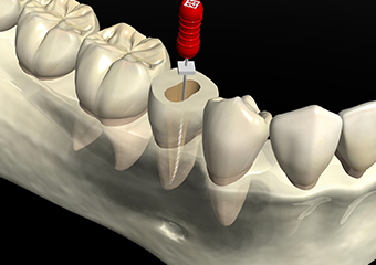 根管治療 イメージ画像