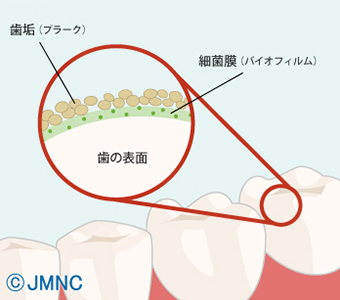 歯周病 イラスト