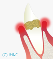 軽度歯周炎 イラスト